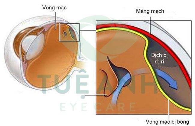 TÌM HIỂU BỆNH LÝ RÁCH VÕNG MẠC