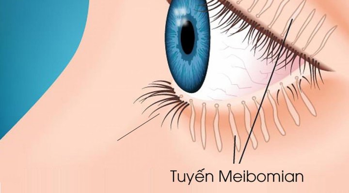 RỐI LOẠN CHỨC NĂNG TUYẾN MEIBOMIUS