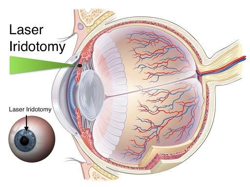 BỆNH GLÔCÔM - ĐIỀU TRỊ NHƯ THẾ NÀO?