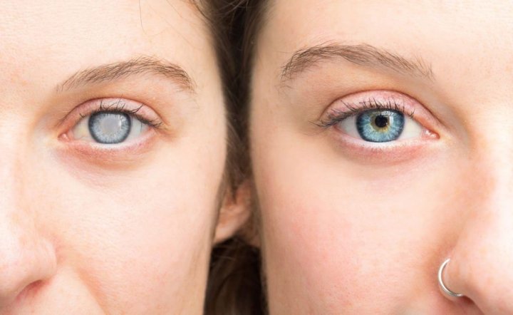 Hướng dẫn cách phân loại đục thủy tinh thể chi tiết